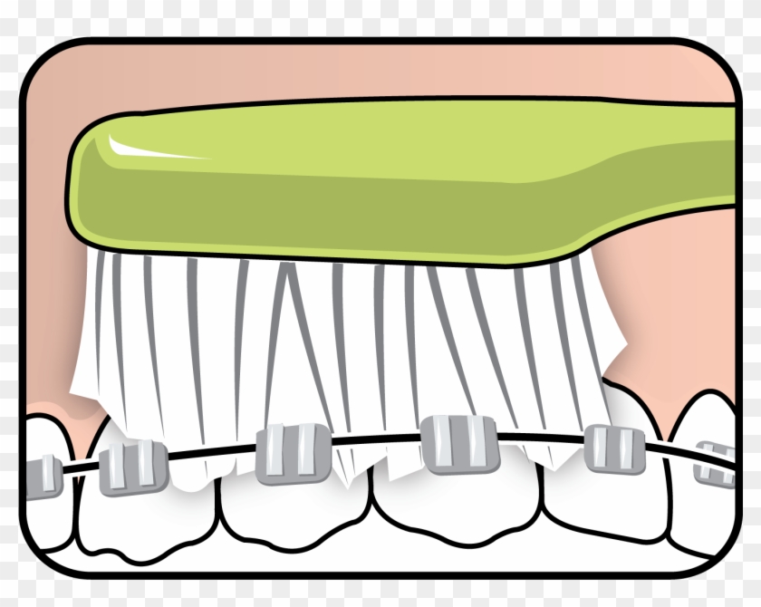 Tepe Supreme On Braces - Tepe Supreme On Braces #1599656