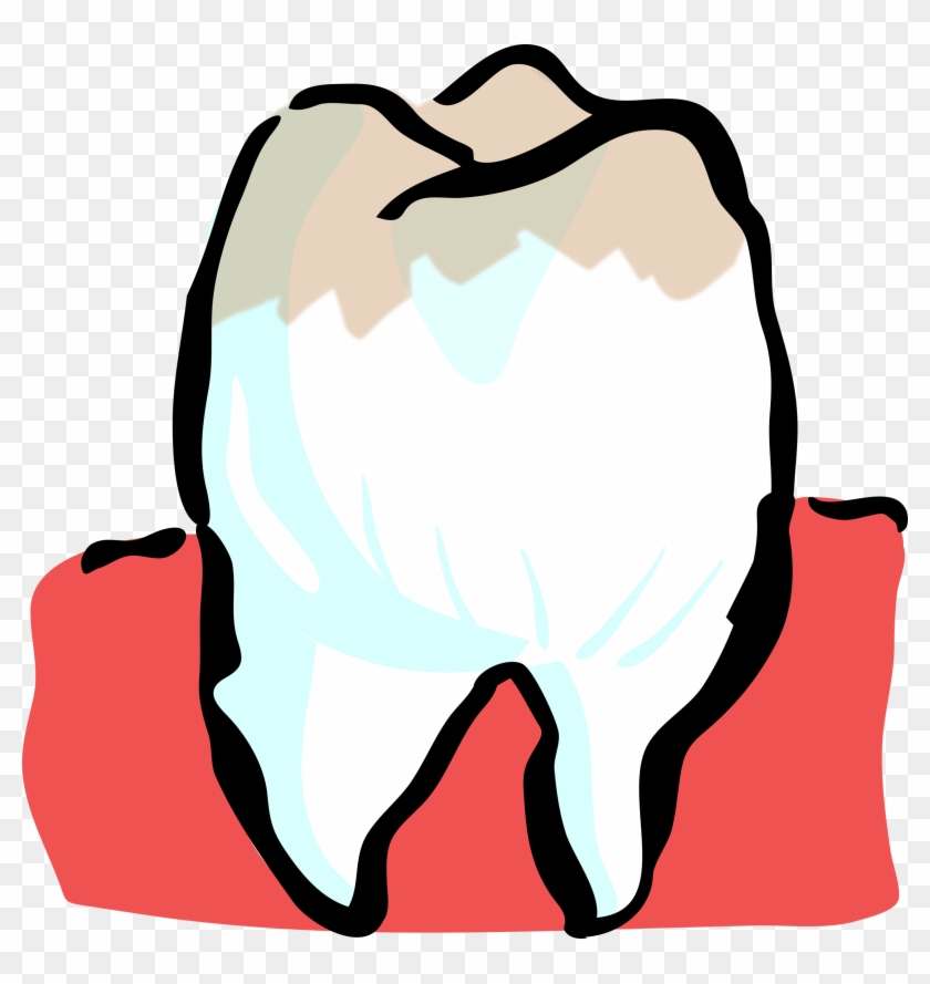Human Tooth Dentistry Tooth Decay Periodontal Disease - Teeth Clipart #1602139