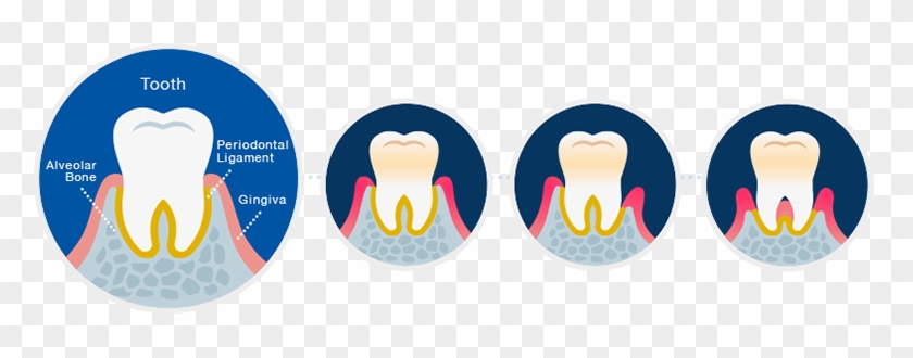 Healthy Tooth Gingivitis Moderate Periodontitis Severe - Gingivitis And Periodontitis Png #1631698