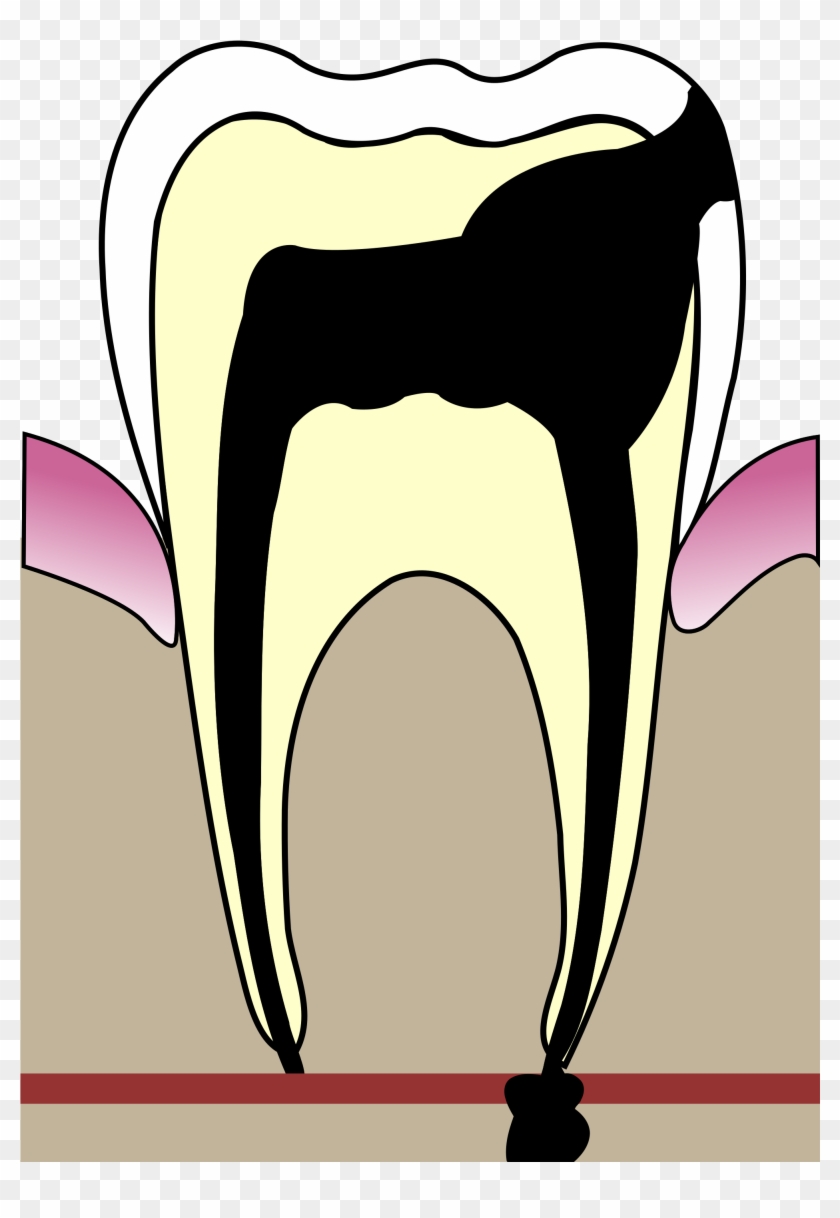 Ear Clipart Hygiene - Cavities In Teeth #1635122