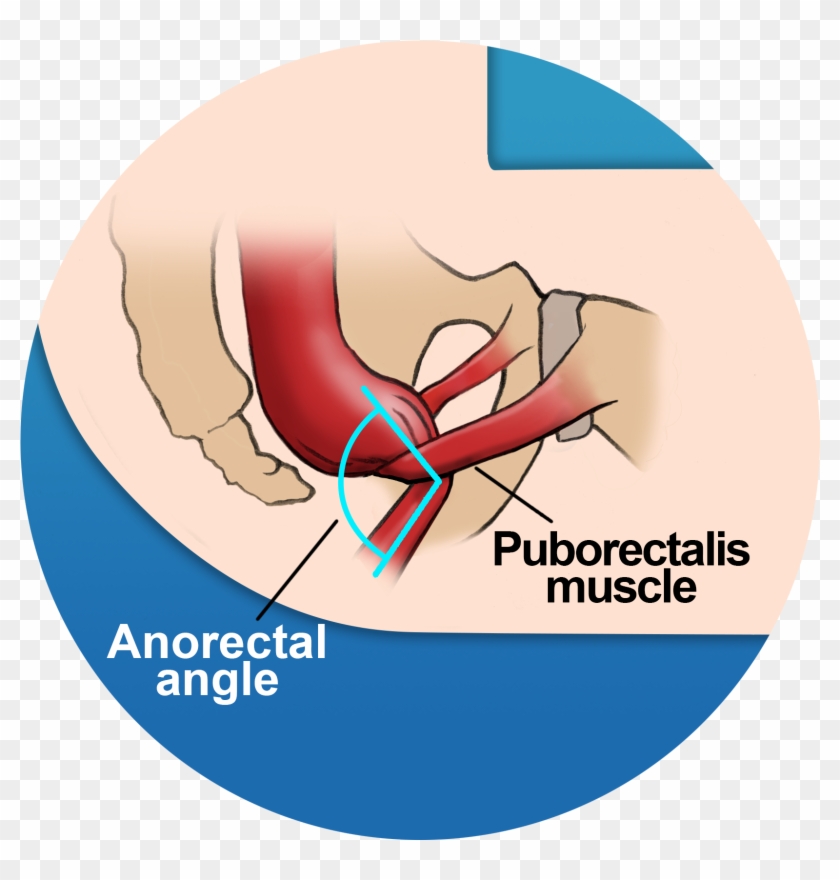 Sitting Causes The Puborectalis Muscle To Tighten - Posizione Per Fare La Cacca #1636465