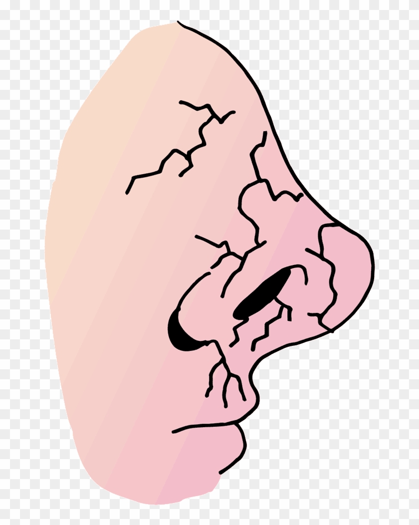 This Infections Can Be Associated With Dry Nasal Lining - Nariz Seca #1637581