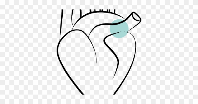 Pulmonary Arterial Hypertension When The Pressure In - Line Art #1651721