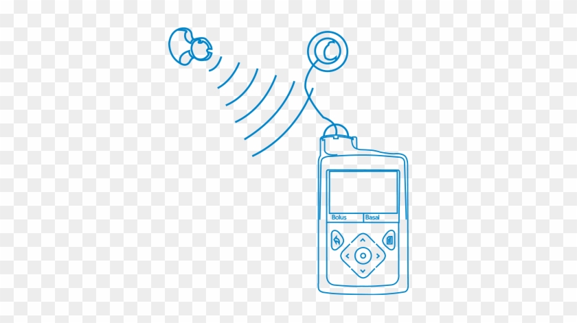 How Does Continuous Glucose Monitoring Work - How Does Continuous Glucose Monitoring Work #1663330