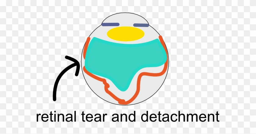 In Some Patients, The Vitreous Tug Can Cause The Retina - In Some Patients, The Vitreous Tug Can Cause The Retina #1673239