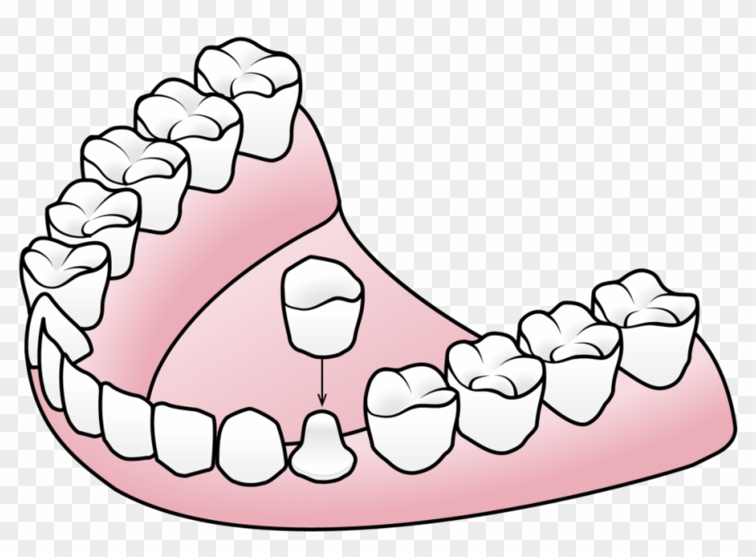 Porcelain Crowns Valley Dental And Orthodontics Clipart - Component Of Partial Denture #1677415