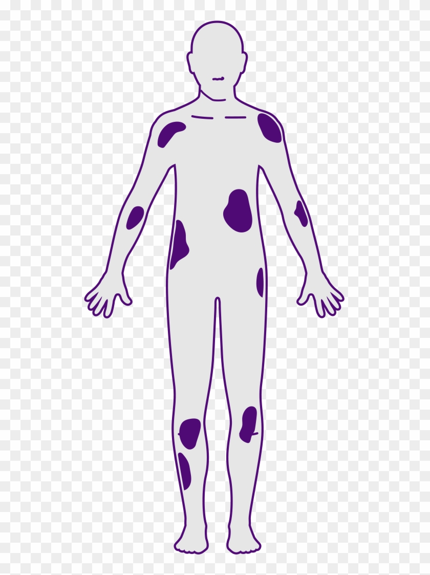 Plaque Psoriasis Severity - Plaque Psoriasis Severity #1701192