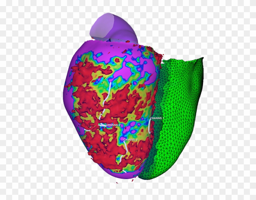 Electrophysiologist To Identify The Arrhythmia Substrate - Illustration #1702607