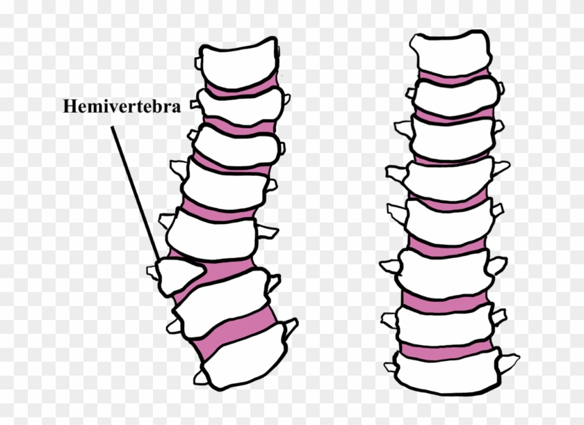 Hemivertebrae Dogs - Hemivertebra Bulldog #1753141