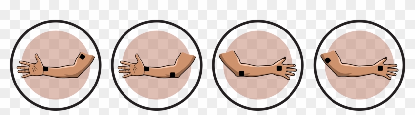 Ulnar Nerve Lesion - Kappa #1763858