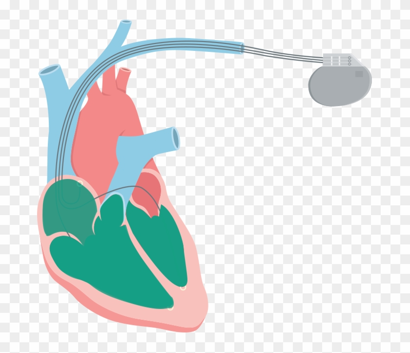 Systolic Heart Failure Also Called Systolic Left Ventricular - Systolic Heart Failure Also Called Systolic Left Ventricular #309004