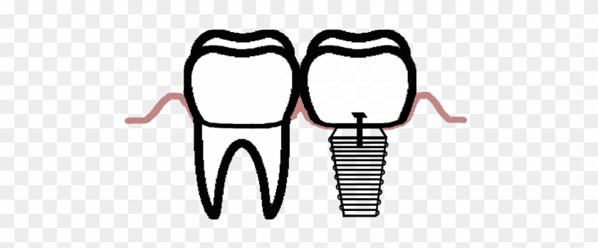 Dental Implants - Dental Implants #386713