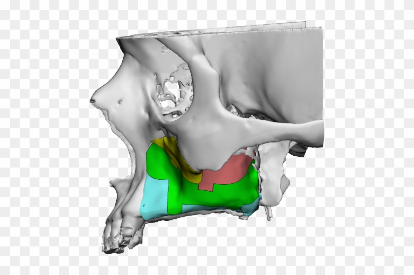 Large Maxillofacial Reconstruction Case With Smartbone® - Skull #419328