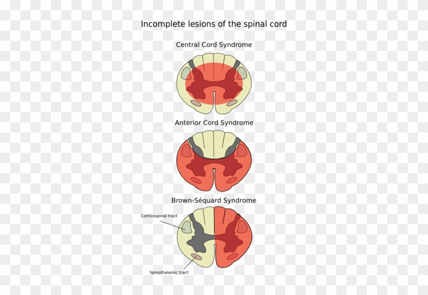 Anasarca Anterior Spinal Artery Syndrome - Spinal Cord Injury Brown Sequard Syndrome #454770