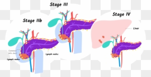 Illustration Of Stages Iib, Iii, And Iv Of Pancreatic - 4 Pancreatic Cancer Stages That Help You